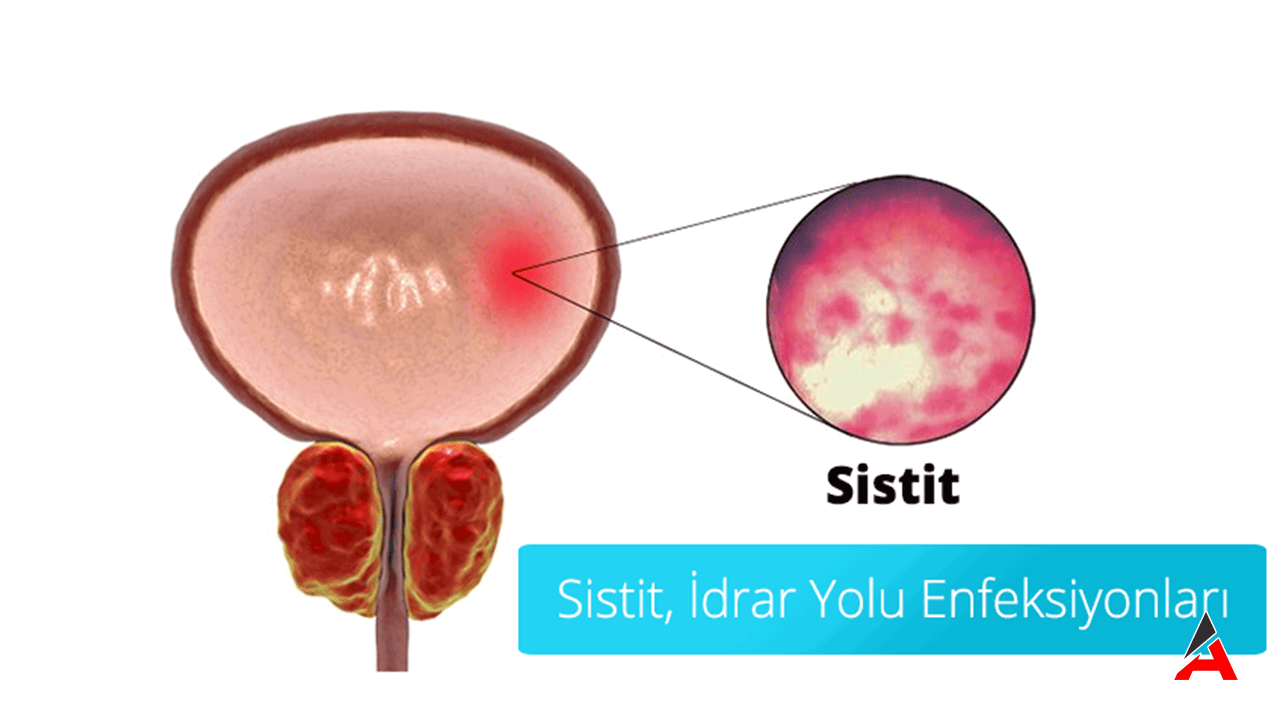 sistit-nedir-kadinlarda-idrar-yolu-enfeksiyonunun-temel-belirtileri.png