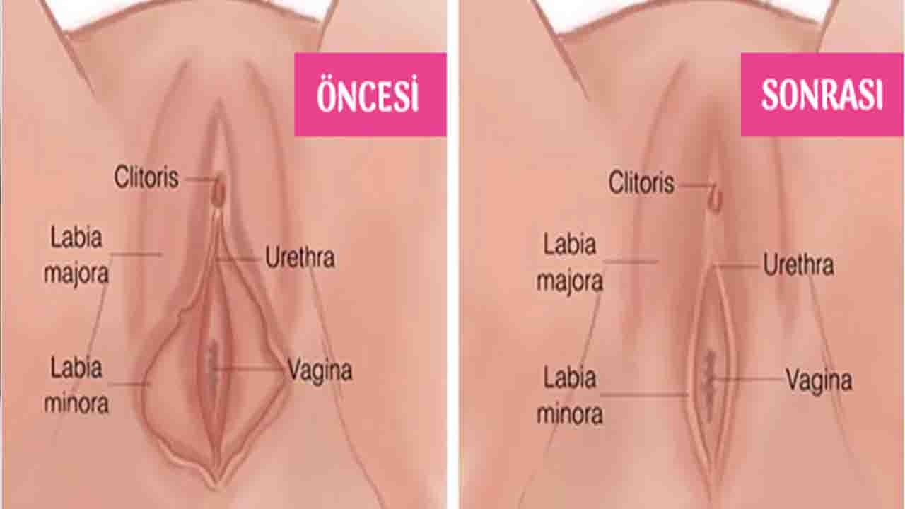 Labioplasti Nedir Kimler İçin Uygun